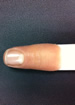 Vinger epithese
